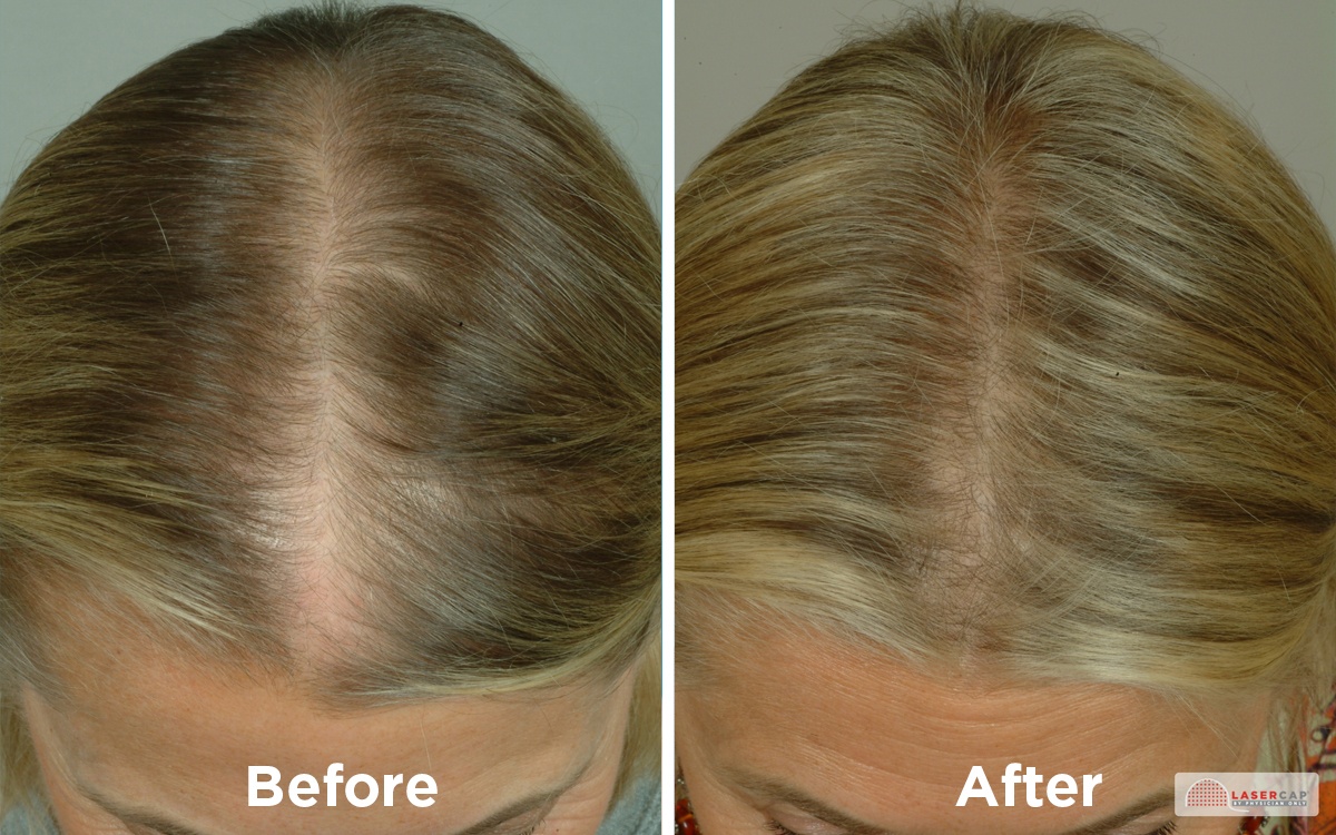 Female Hair Loss is not uncommon, women make up a 40% of hair loss s