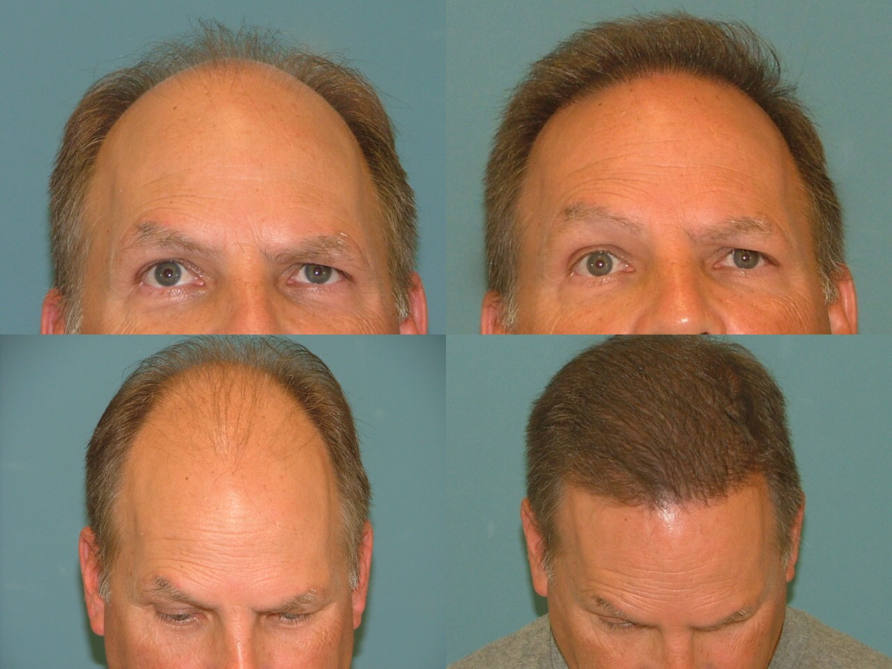 Estetigraft hair restoration