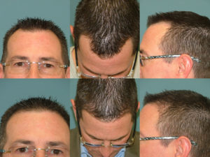 Hair Restoration at Estetica Institute of the Palm Beaches