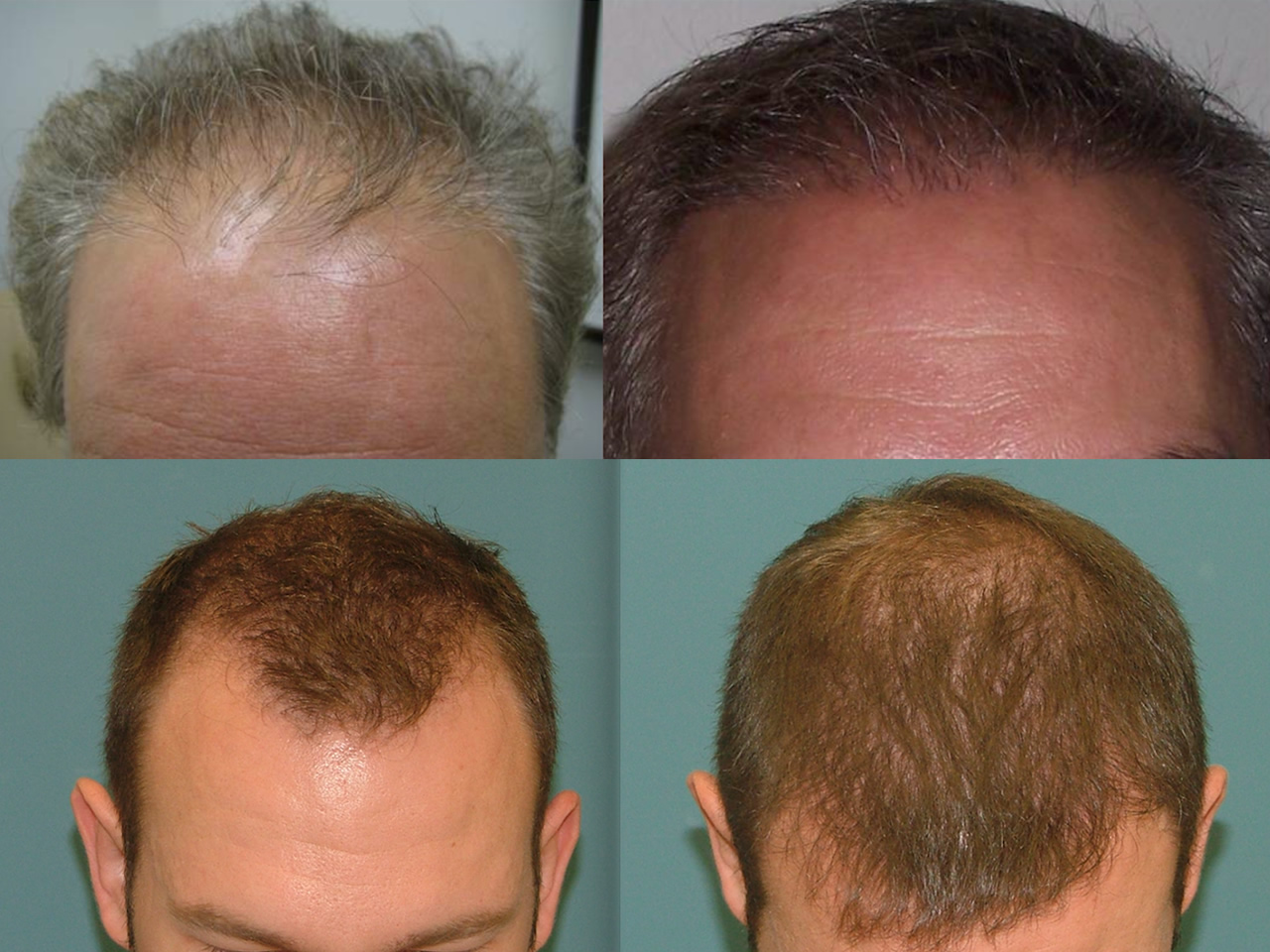 Estetigraft hair restoration